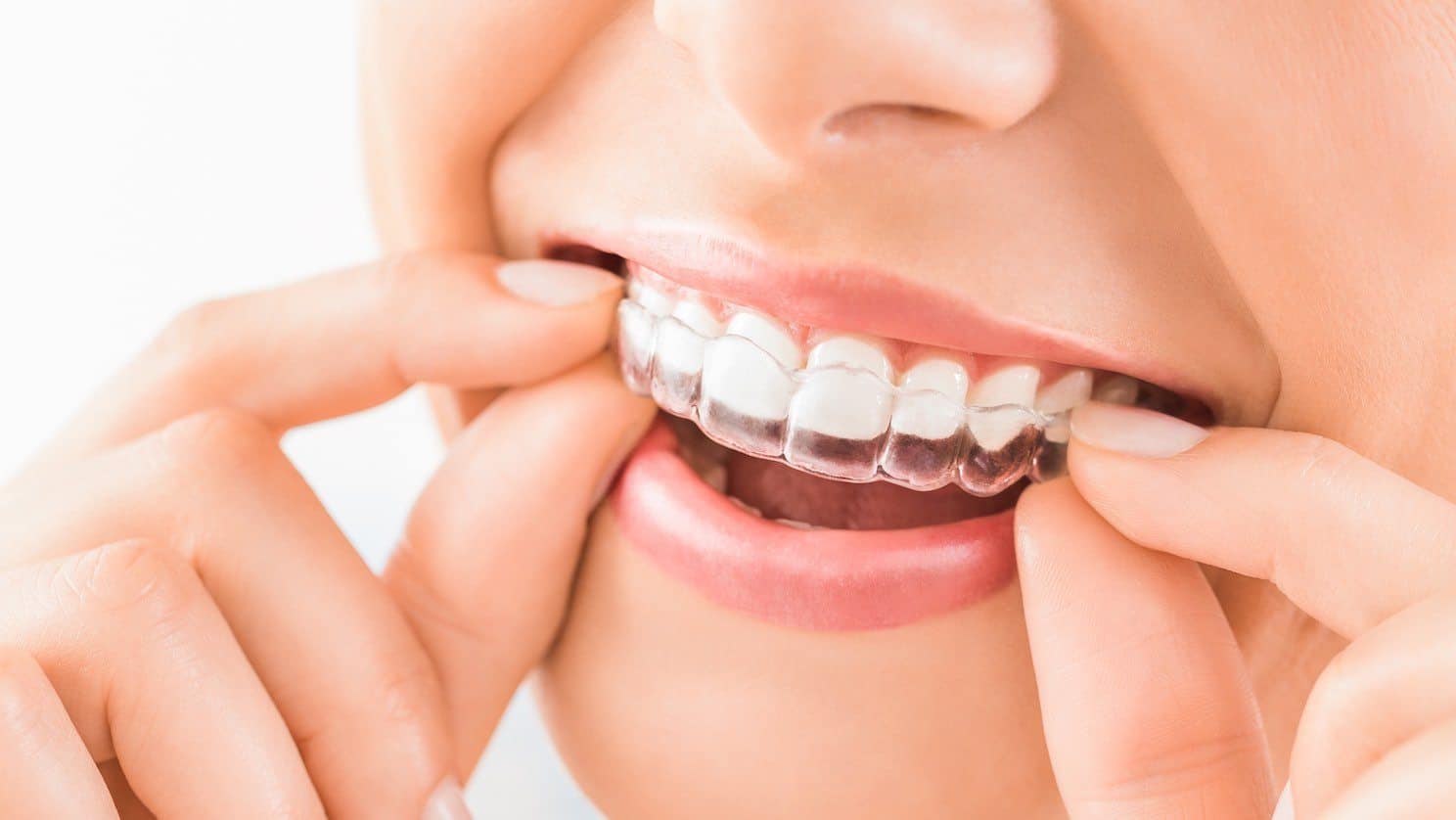 teeth aligners